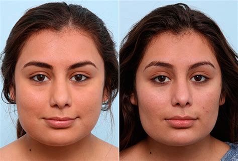 Buccal Fat Pad Removal and Fat Grafting .